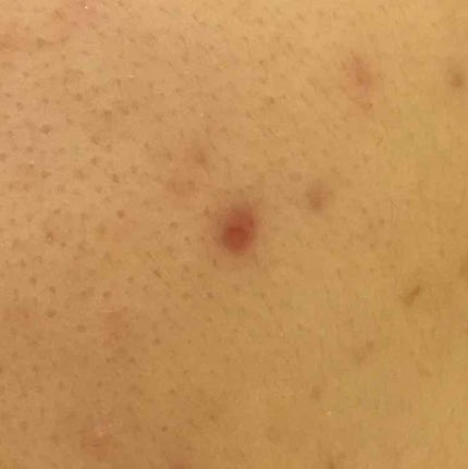 薬用 しみ 集中対策 美容液/メラノCC/美容液を使ったクチコミ(2枚目)