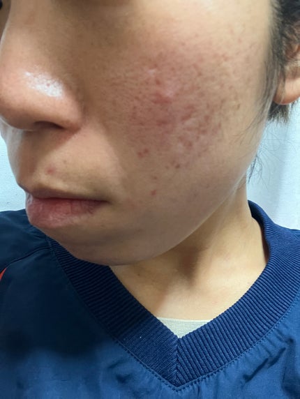 𐐪𝓐𝓴𝓲𐑂 on LIPS 「2日目【43℃⠀】メイクをしました。43℃温水の原因なのか。ま..」(2枚目)