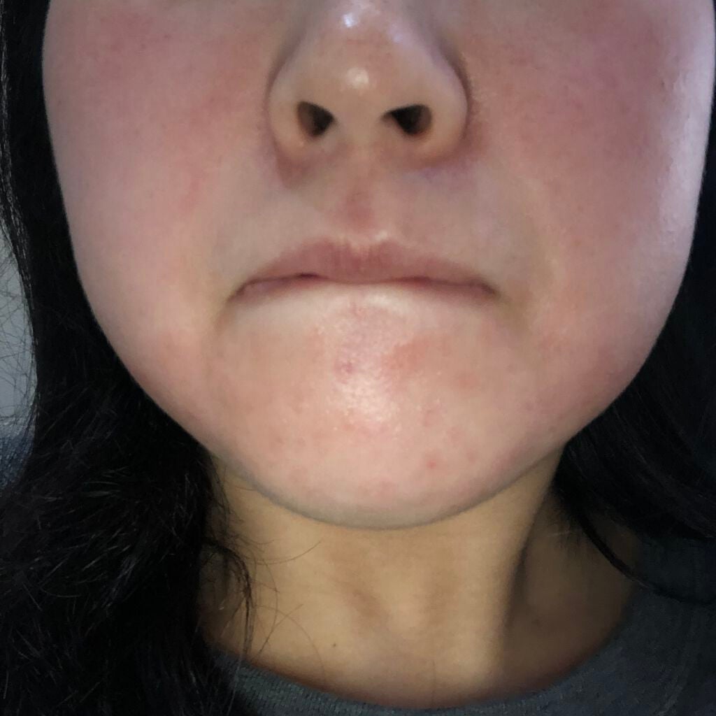 aiai on LIPS 「べピオゲル5日目皮のめくれと痛みが凄い。けど赤みはだいぶましか..」(1枚目)