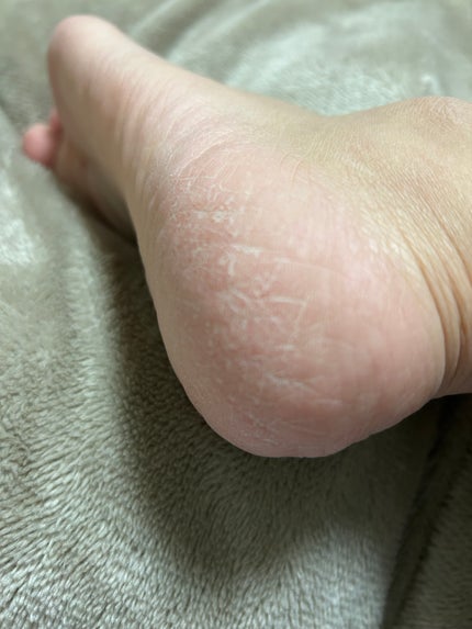 ネイチャーコンク薬用フットケアローション/ネイチャーコンク/レッグ・フットケアを使ったクチコミ(1枚目)