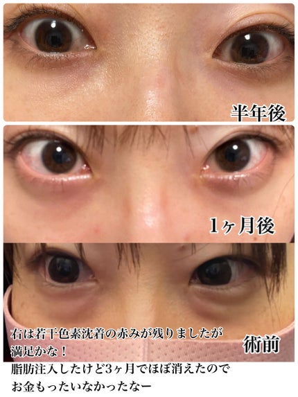 【旧】ディオールスキン フォーエヴァー スキン コレクト コンシーラー/Dior/リキッドコンシーラーを使ったクチコミ(7枚目)