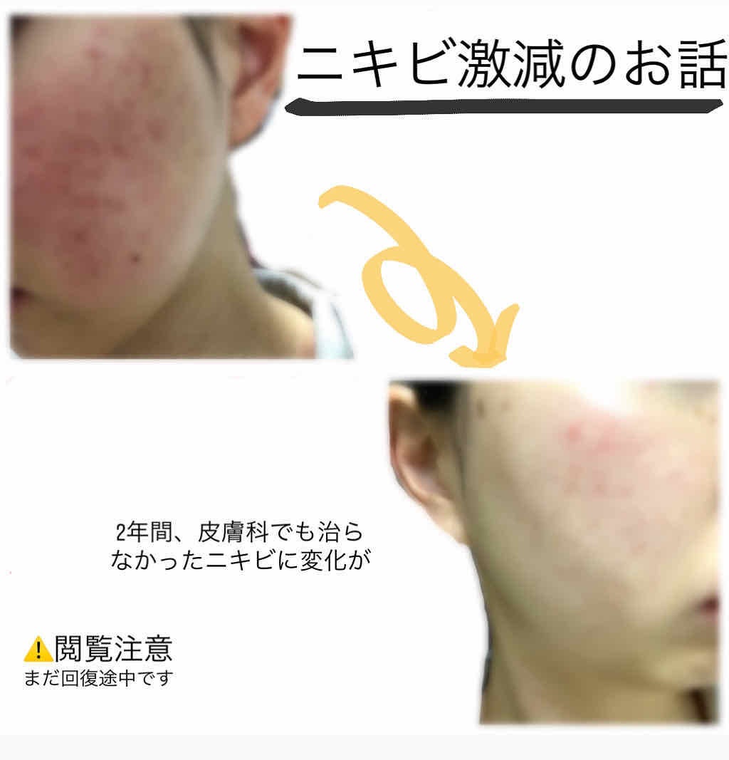 モイストバランス ローション/ACSEINE/化粧水を使ったクチコミ(1枚目)