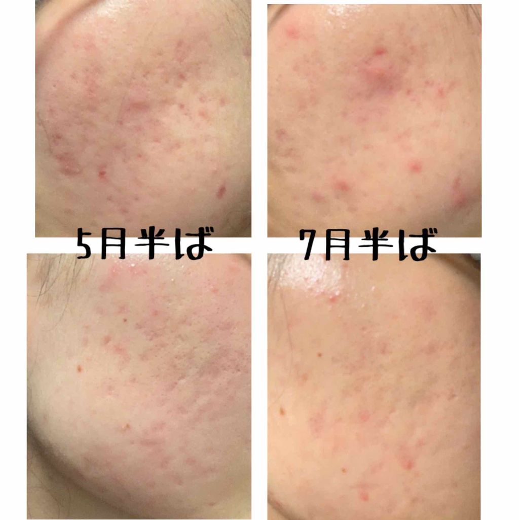 まな on LIPS 「どうも。⚠️2枚目にニキビ肌の画像があります⚠️更新をサボって..」(2枚目)