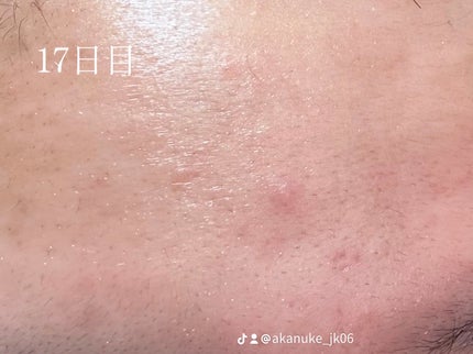 ðââïžð«° on LIPS ãã€ãœãã¬ããã€ã³ã®çµéðãã£ãšããã¯ããŠããã§ããã©ã1æ¥ãµã..ãïŒ5æç®ïŒ