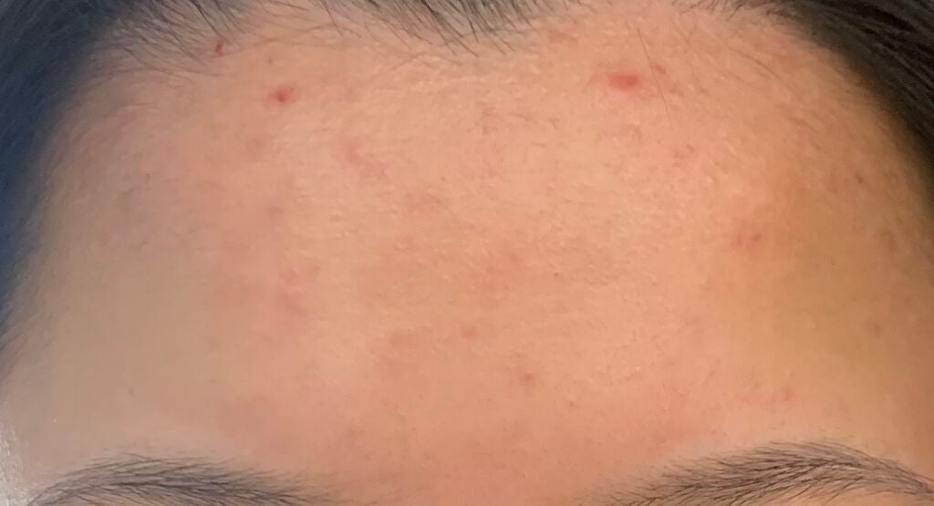 akn on LIPS 「⚠️2枚目肌、3枚目おでこがアップで写ります⚠️高校2年生です..」(3枚目)