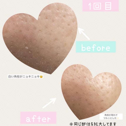 鼻 バブルパック/CNP Laboratory/シートマスク・パックを使ったクチコミ(6枚目)