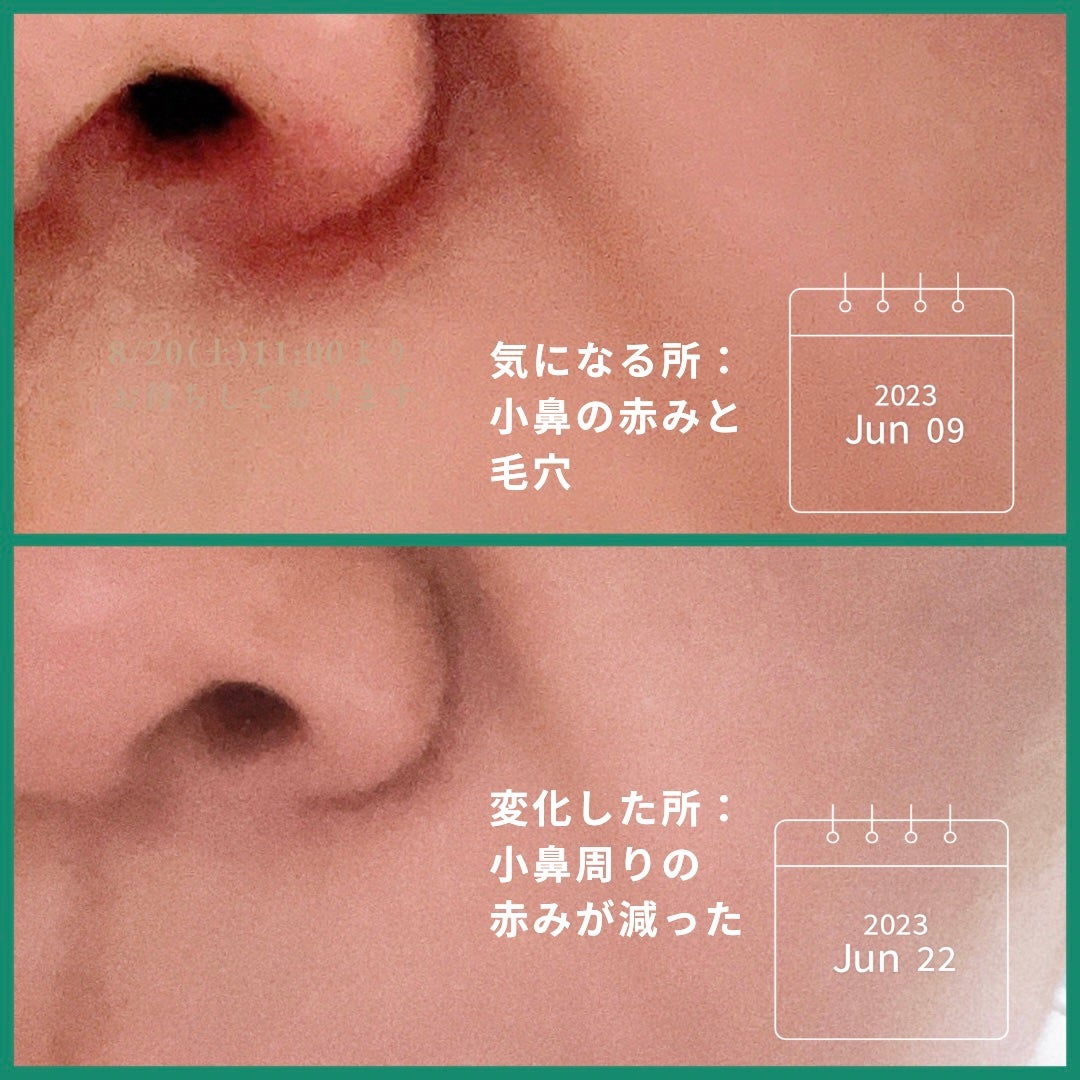yuki_love_kcosme on LIPS 「【VTCosmetics】高濃度シカレチAエッセンス0.3/0..」(3枚目)