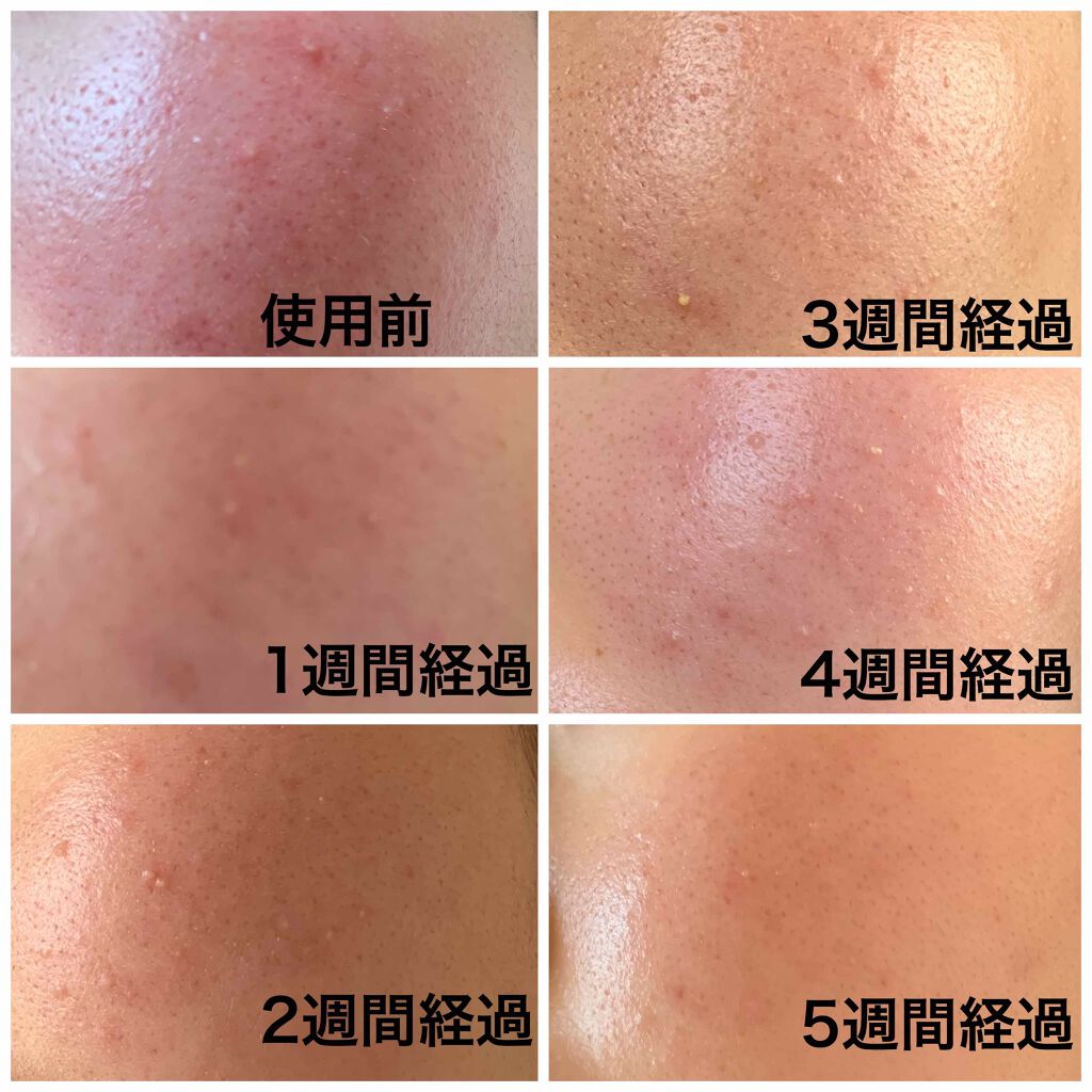 薬用しみ対策 美白化粧水 しっとりタイプ/メラノCC/化粧水を使ったクチコミ（3枚目）