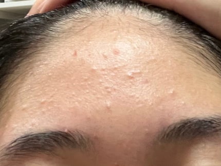 ゆゆ on LIPS 「ニキビ、沢山増えてしまいました泣一昨日皮膚科にやっと行き始めま..」(4枚目)