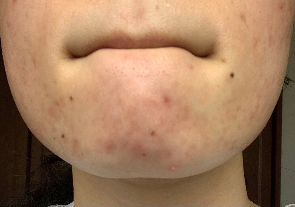 ちい on LIPS 「【私のニキビ日記】⚠️ニキビ肌の写真があります!苦手な方はご注..」(4枚目)