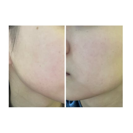 ぽむ on LIPS 「2023.9.13皮膚科に受診 エピデュオとヘパリン処方1枚目..」(4枚目)