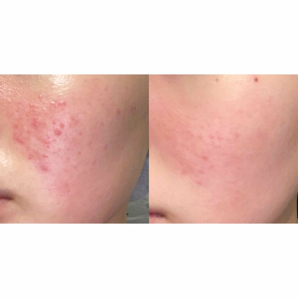 ベピオゲル/マルホ株式会社/その他を使ったクチコミ（2枚目）