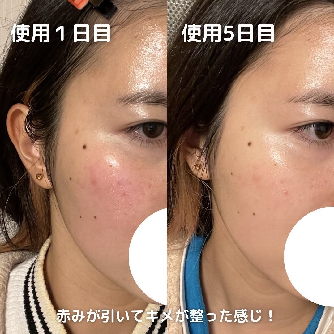 マイルドリードルショット50/VT/美容液を使ったクチコミ(5枚目)