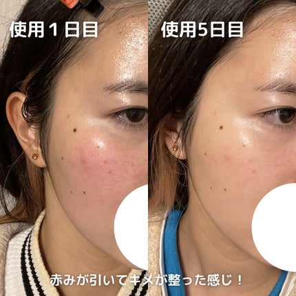 マイルドリードルショット50/VT/美容液を使ったクチコミ(5枚目)