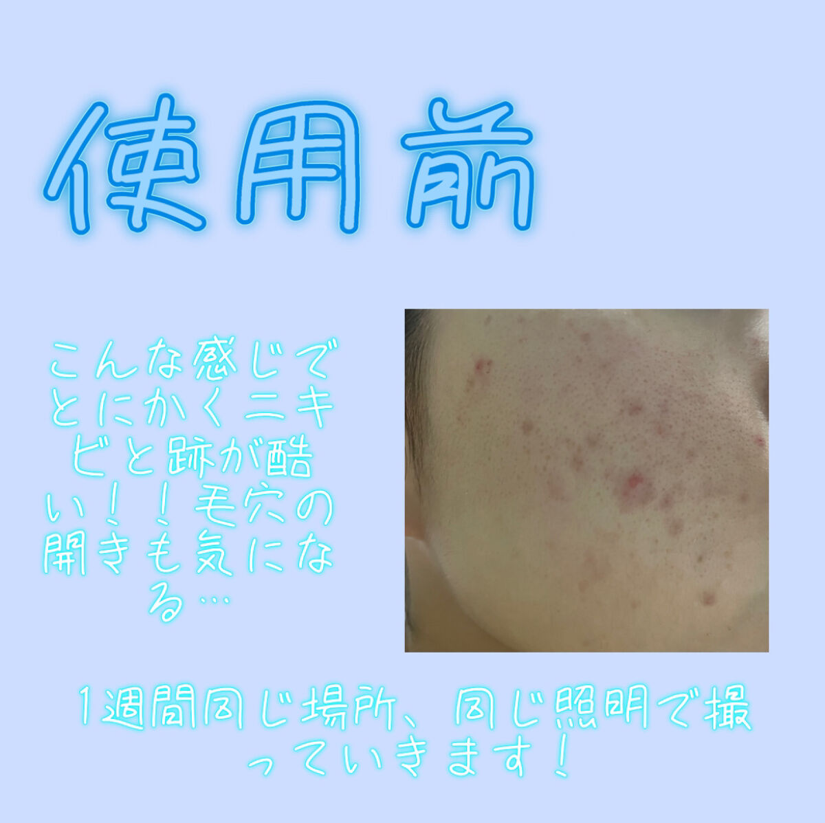 CHOI薬用フェイスウォッシュ ニキビケア ［医薬部外品］/肌美精/洗顔フォームを使ったクチコミ（3枚目）