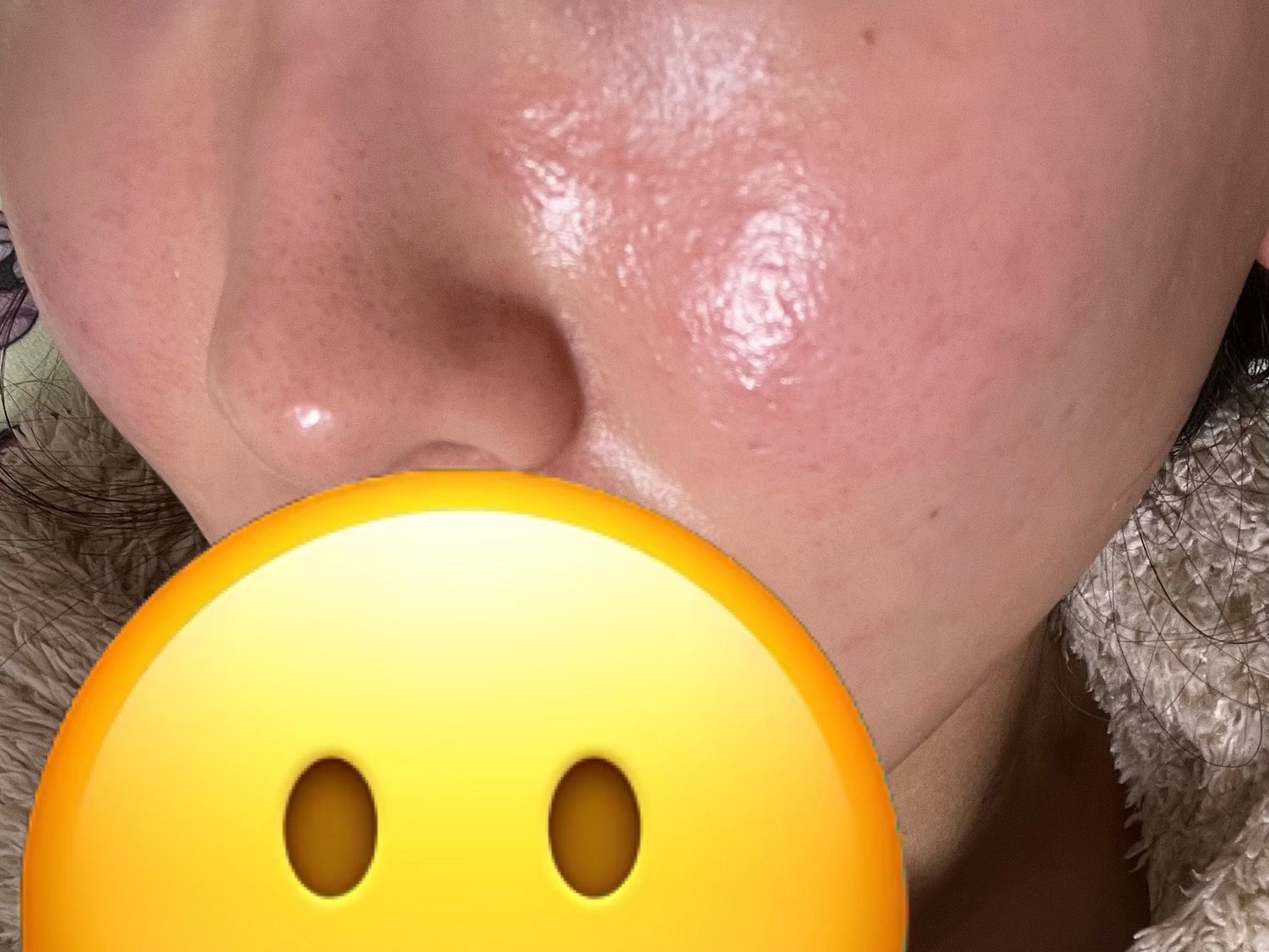 アクネケア 化粧液　＜医薬部外品＞/ファンケル/化粧水を使ったクチコミ（2枚目）