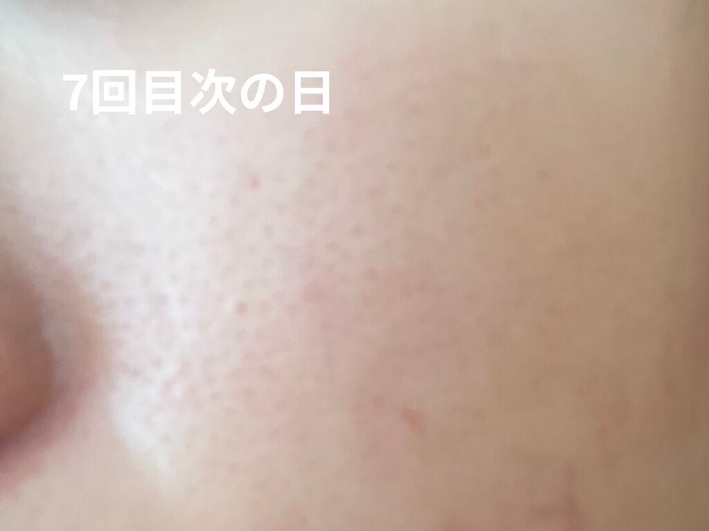 レチノールA 1% アドバンスドリバイタリゼーションクリーム/Life-flo/フェイスクリームを使ったクチコミ(7枚目)