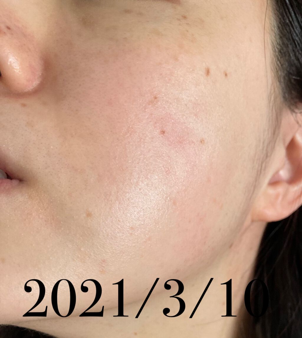 薬用 しみ 集中対策 美容液/メラノCC/美容液を使ったクチコミ（3枚目）