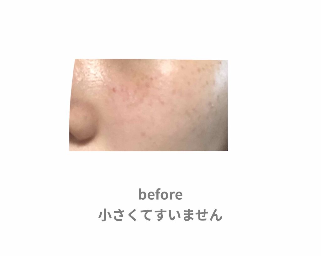 薬用 しみ 集中対策 美容液/メラノCC/美容液を使ったクチコミ(2枚目)