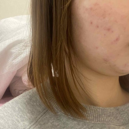 クリンダマイシンゲル(医薬品)/クラシエ薬品/その他を使ったクチコミ(1枚目)