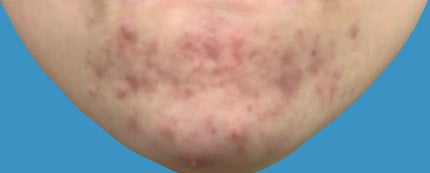 ダラシンTゲル 1% (医薬品)/佐藤製薬/その他を使ったクチコミ(2枚目)