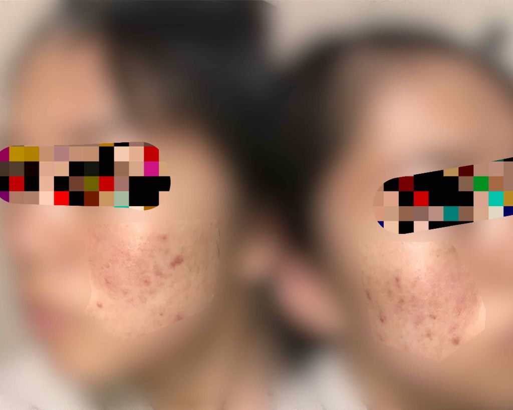 薬用 しみ 集中対策 美容液/メラノCC/美容液を使ったクチコミ（2枚目）