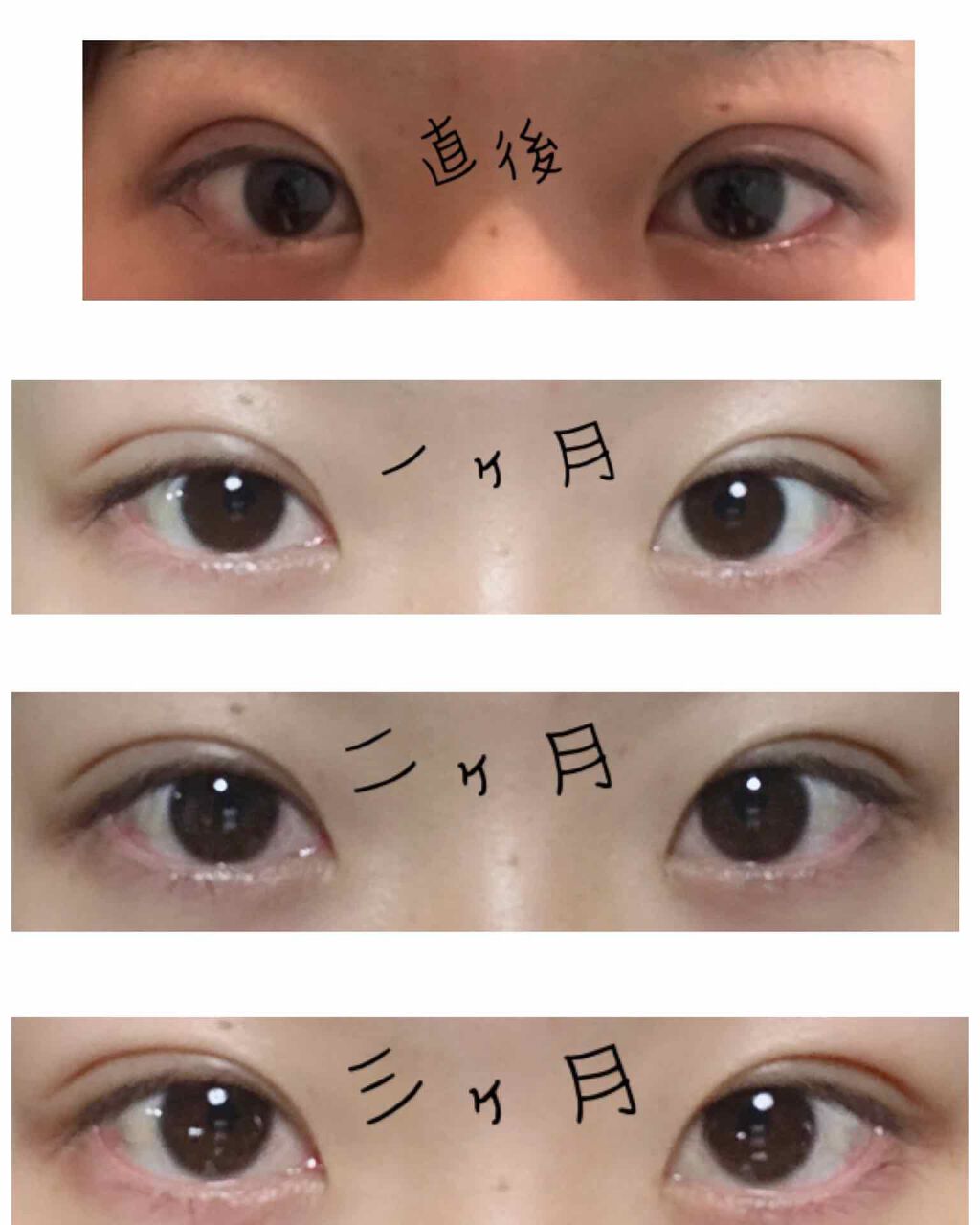 みるくてぃ on LIPS 「埋没後7ヶ月経過しました。(1枚目)元の目やこの種類の施術理由..」(2枚目)