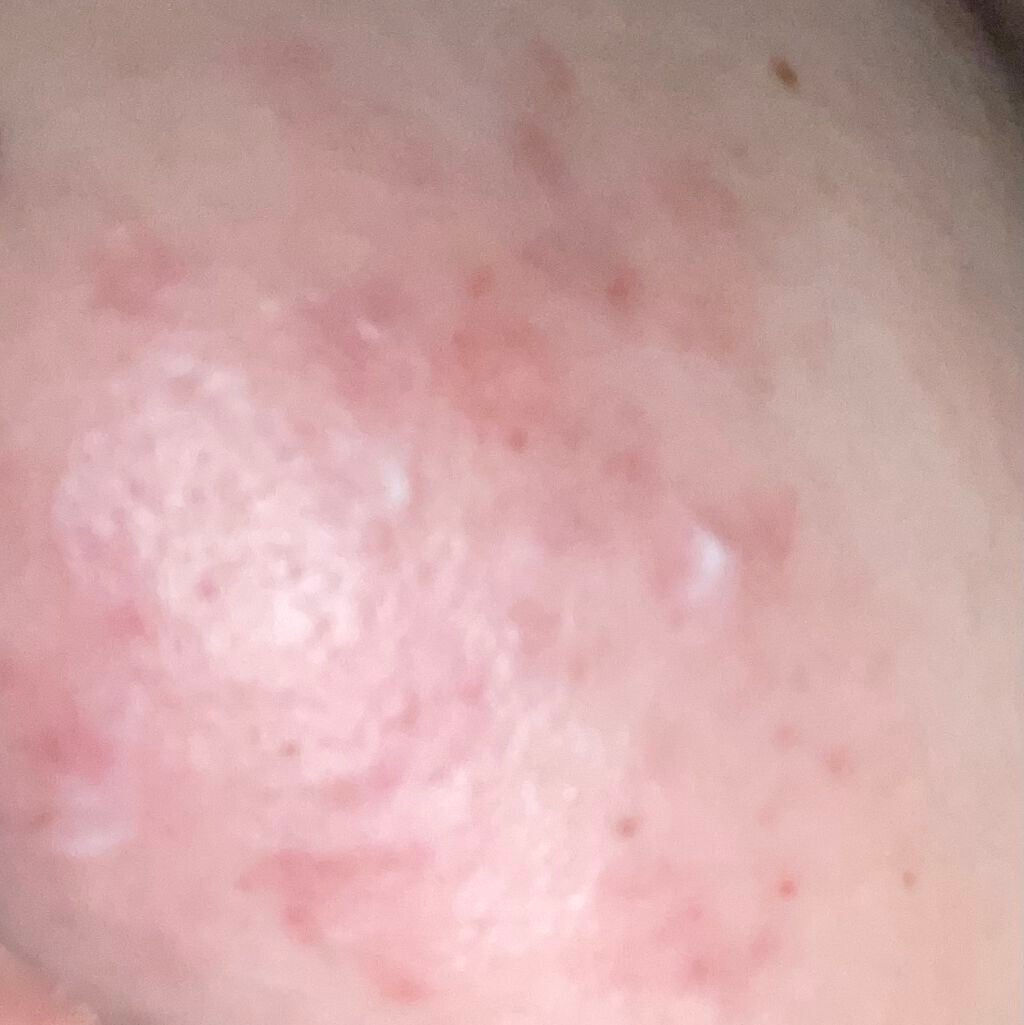 キツネ on LIPS 「もう全然ニキビ治らなくて病む🌀🌀こんなに赤くなって目立つし悪く..」(1枚目)