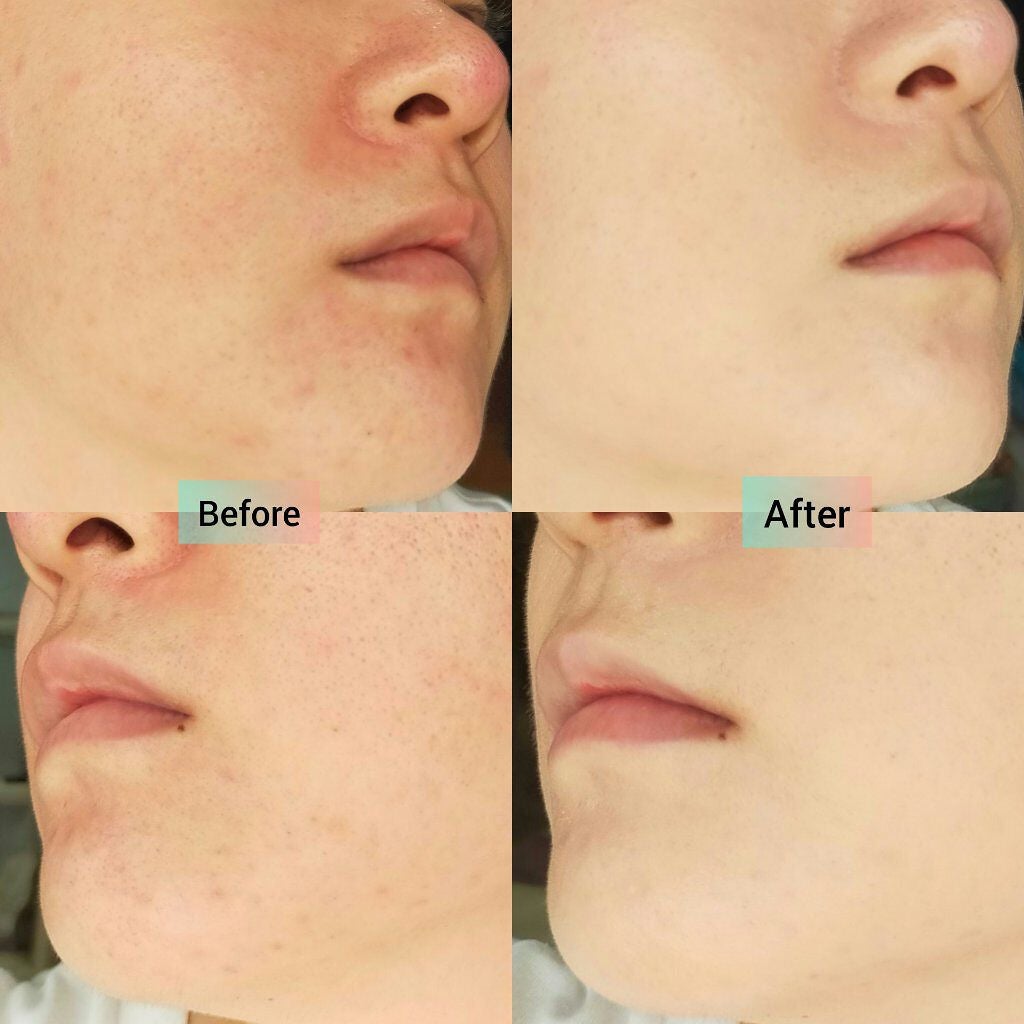 ピンクティーツリーカバークッション/APLIN/クッションファンデーションを使ったクチコミ(4枚目)