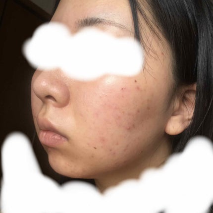 フワフワネコチャン on LIPS 「塗り始めて9日目(10日目朝)の写真です!今日はカメラが汚れて..」(2枚目)