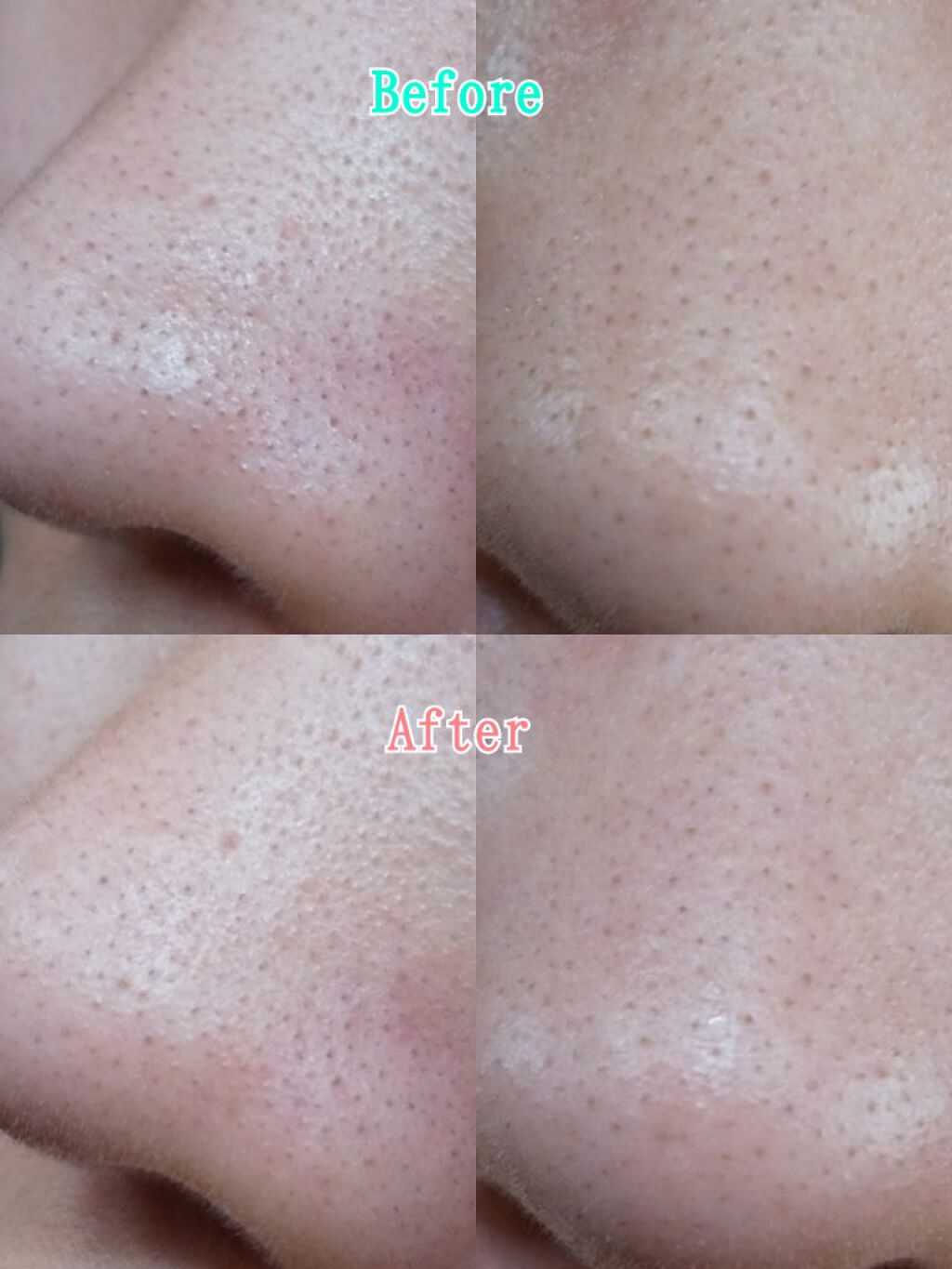 Glycolic Acid 7% Toning  Solution/The Ordinary/ブースター・導入液を使ったクチコミ（3枚目）