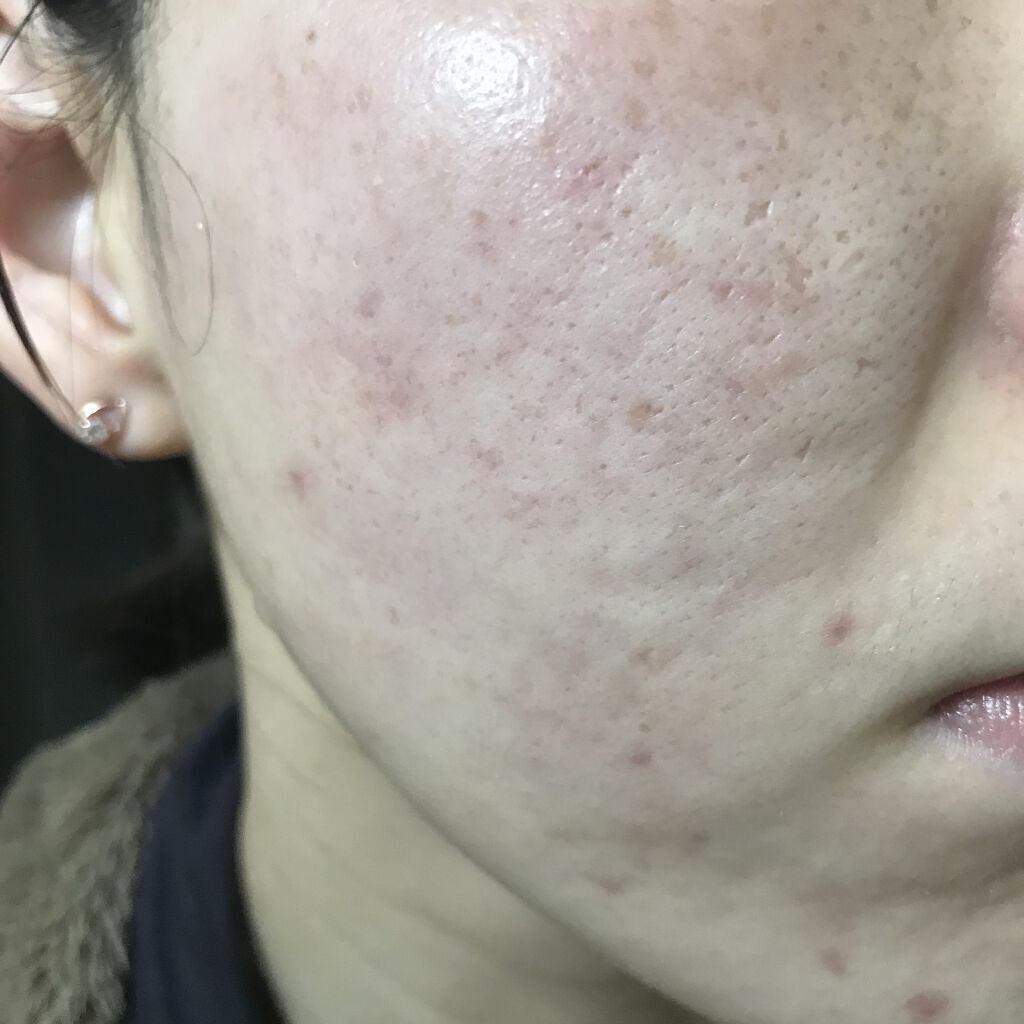 レチノールA 1% アドバンスドリバイタリゼーションクリーム/Life-flo/フェイスクリームを使ったクチコミ（1枚目）