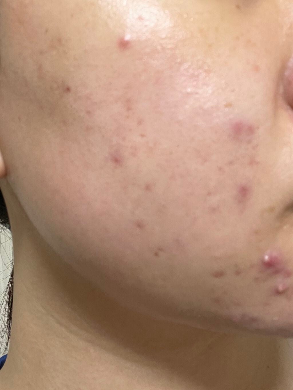 まままこ on LIPS 「ニキビゼロ肌を目指して〜1日目〜⚠️2枚目から肌画像ありスキン..」(2枚目)