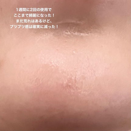 薬用ピーリングスムーサーEX/シーヴァ/ピーリングを使ったクチコミ(4枚目)