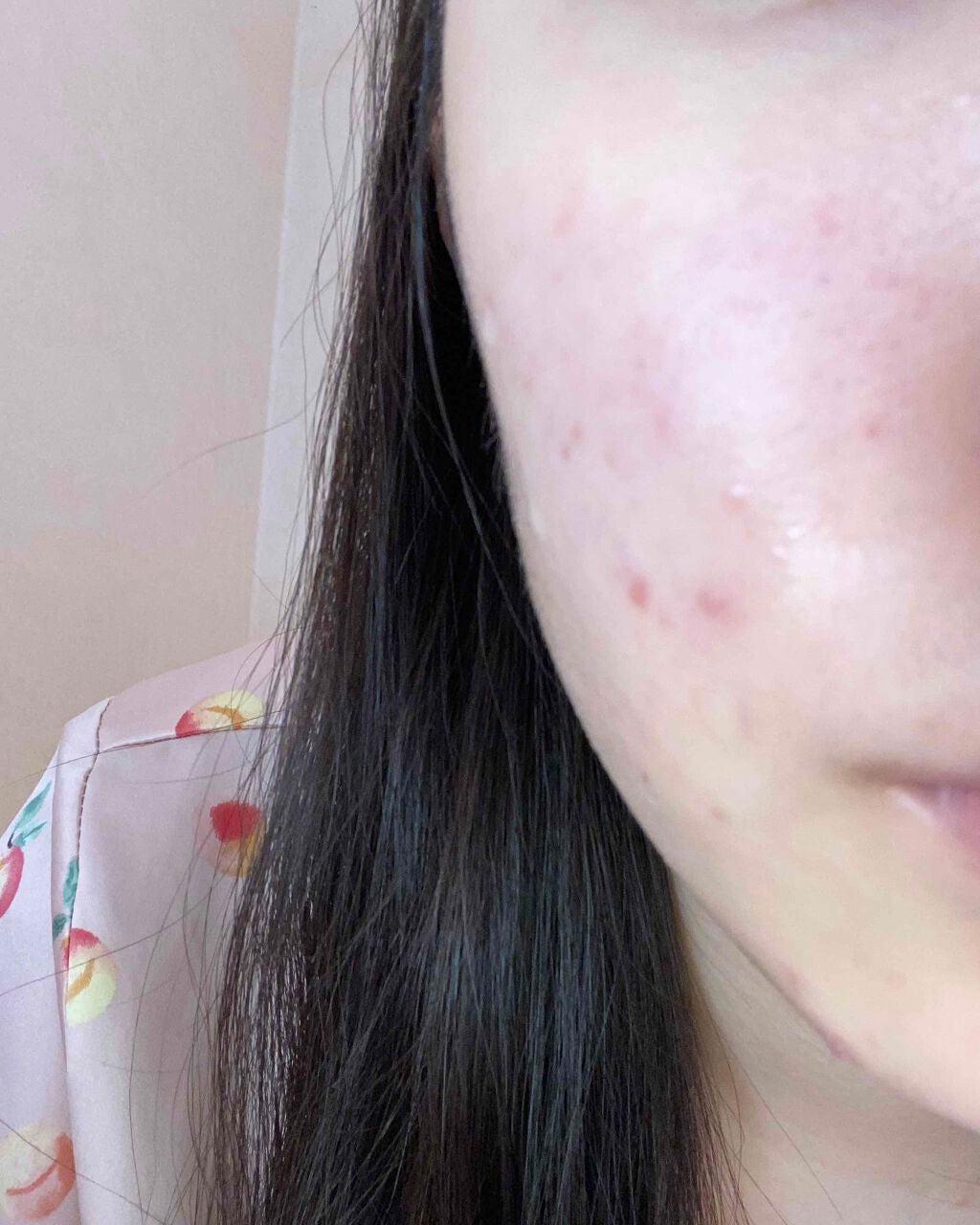 mo on LIPS 「ニキビ治りません皮膚科に行ってもダメでした色んな薬使いましたが..」(8枚目)