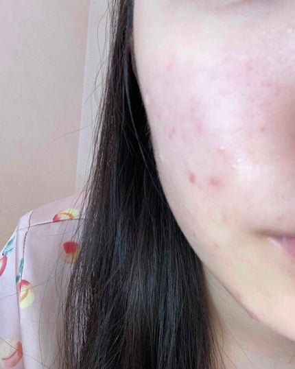 mo on LIPS 「ニキビ治りません皮膚科に行ってもダメでした色んな薬使いましたが..」(8枚目)