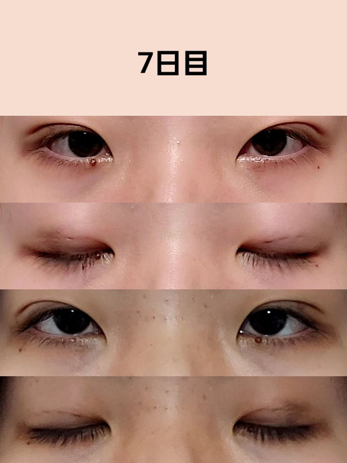 のびーるアイテープ(絆創膏タイプ、レギュラー)/DAISO/二重まぶた用アイテムを使ったクチコミ(5枚目)