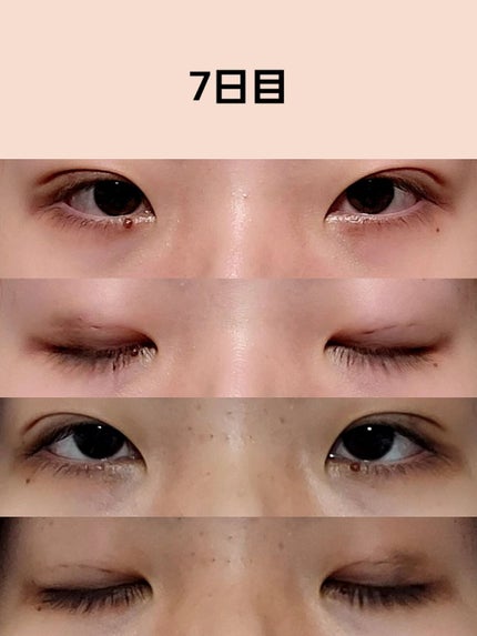 のびーるアイテープ(絆創膏タイプ、レギュラー)/DAISO/二重まぶた用アイテムを使ったクチコミ(5枚目)