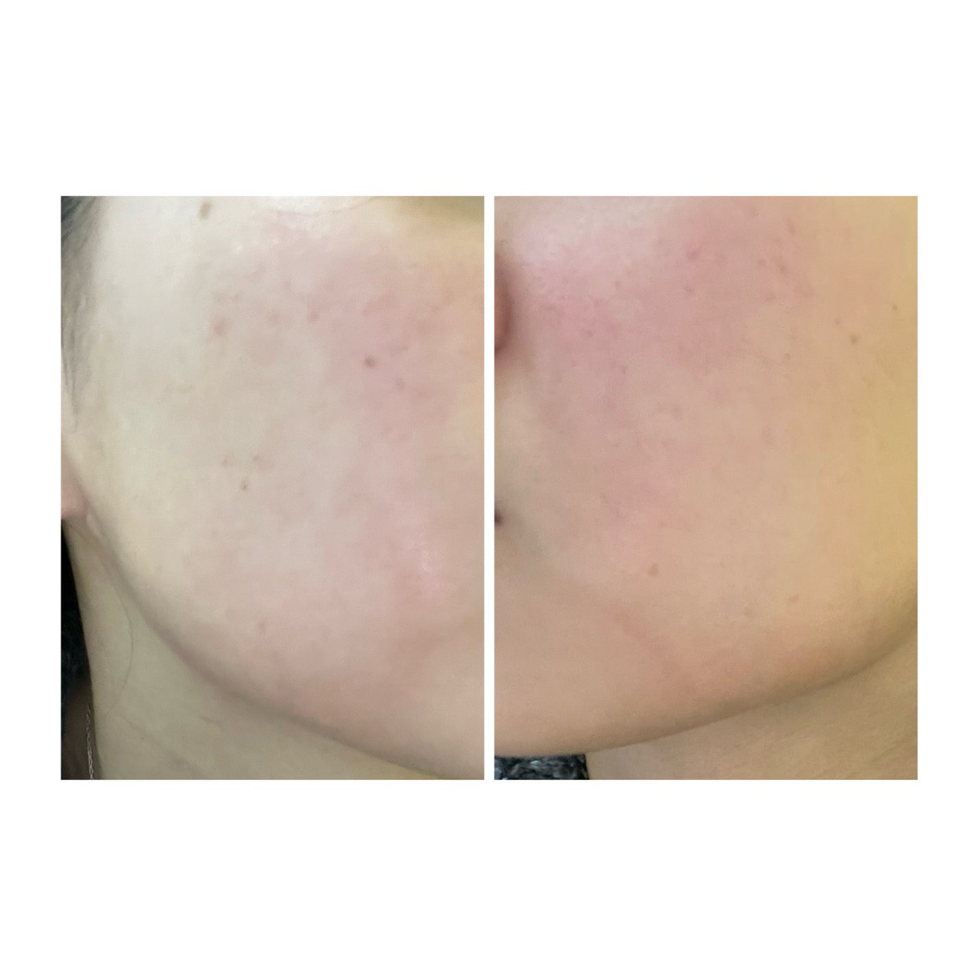 ぽむ on LIPS 「2023.9.13皮膚科に受診 エピデュオとヘパリン処方1枚目..」(3枚目)