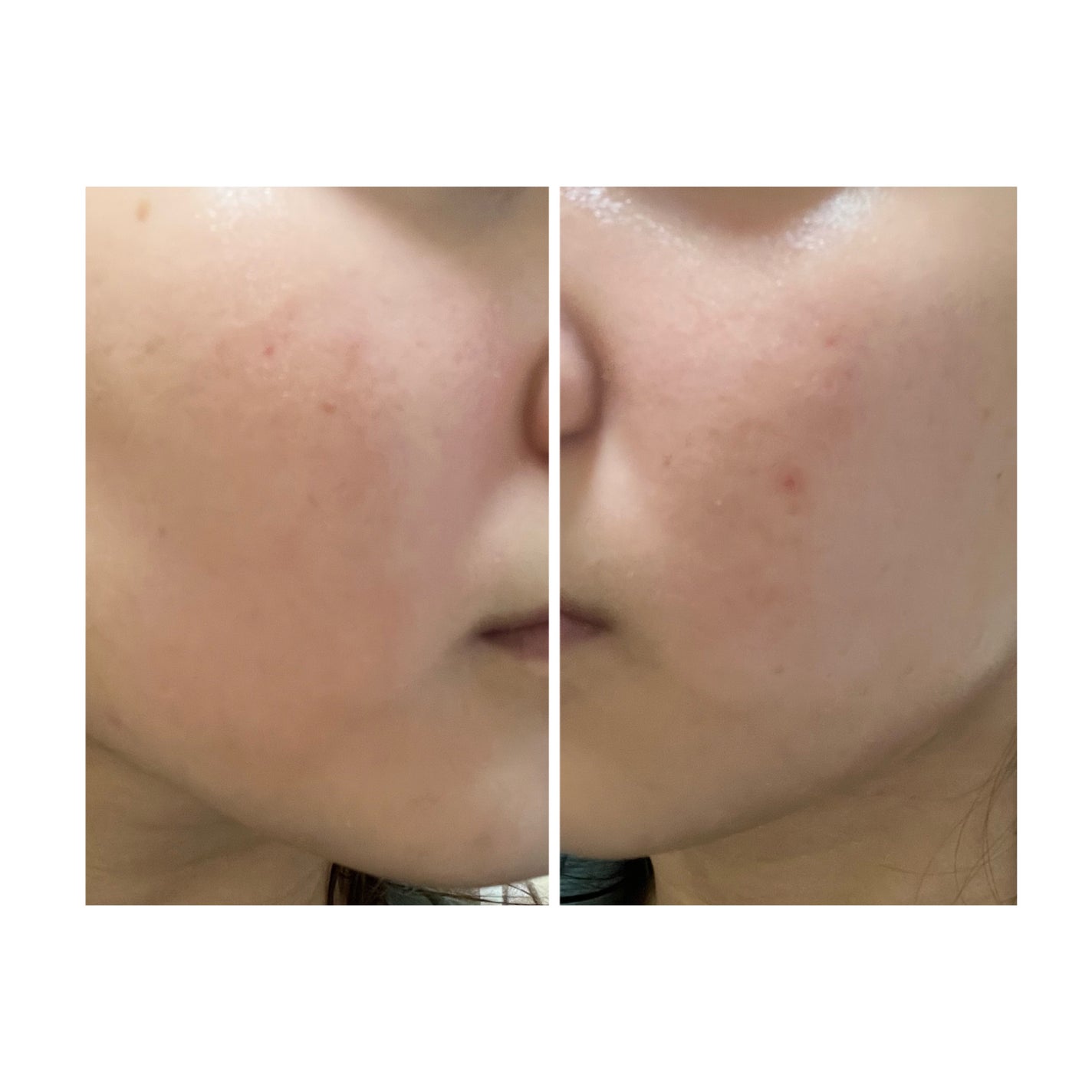 ぽむ on LIPS 「2023.9.13皮膚科に受診 エピデュオとヘパリン処方1枚目..」(4枚目)