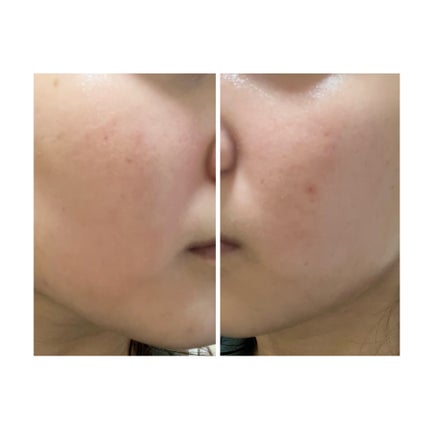 ぽむ on LIPS 「2023.9.13皮膚科に受診 エピデュオとヘパリン処方1枚目..」(4枚目)