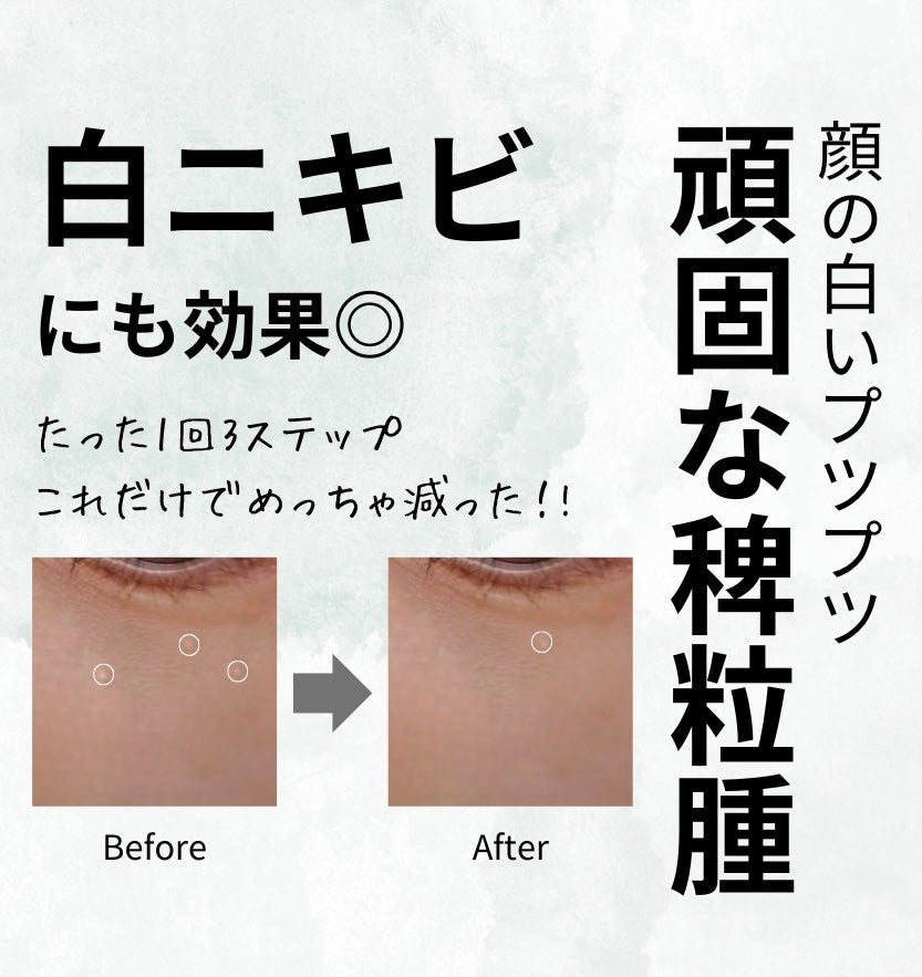 薬用クリア化粧水/メンソレータム アクネス/化粧水を使ったクチコミ(1枚目)