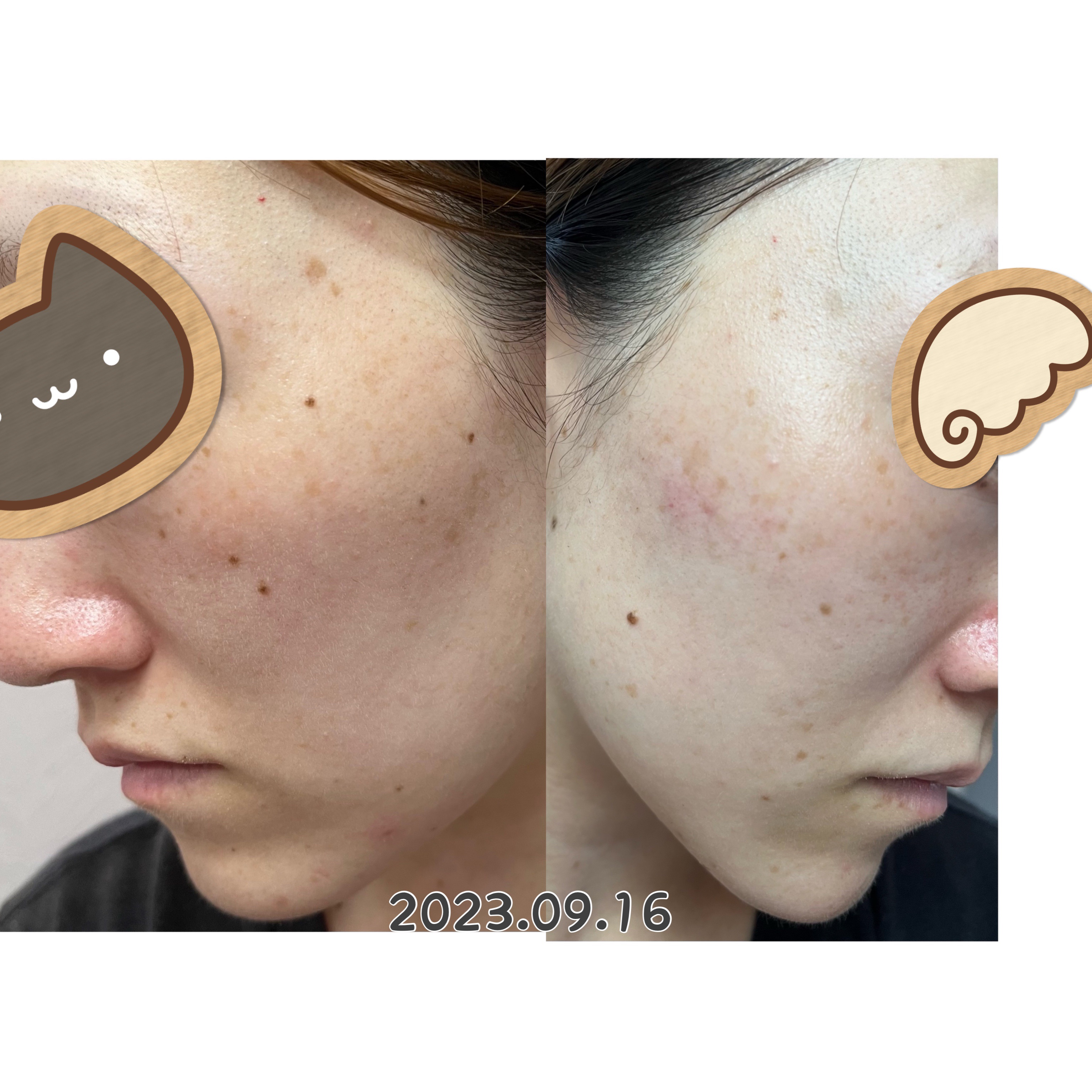 EUKROMA　ハイドロキノンクリーム4%　20g/EUKROMA/その他スキンケアを使ったクチコミ（1枚目）