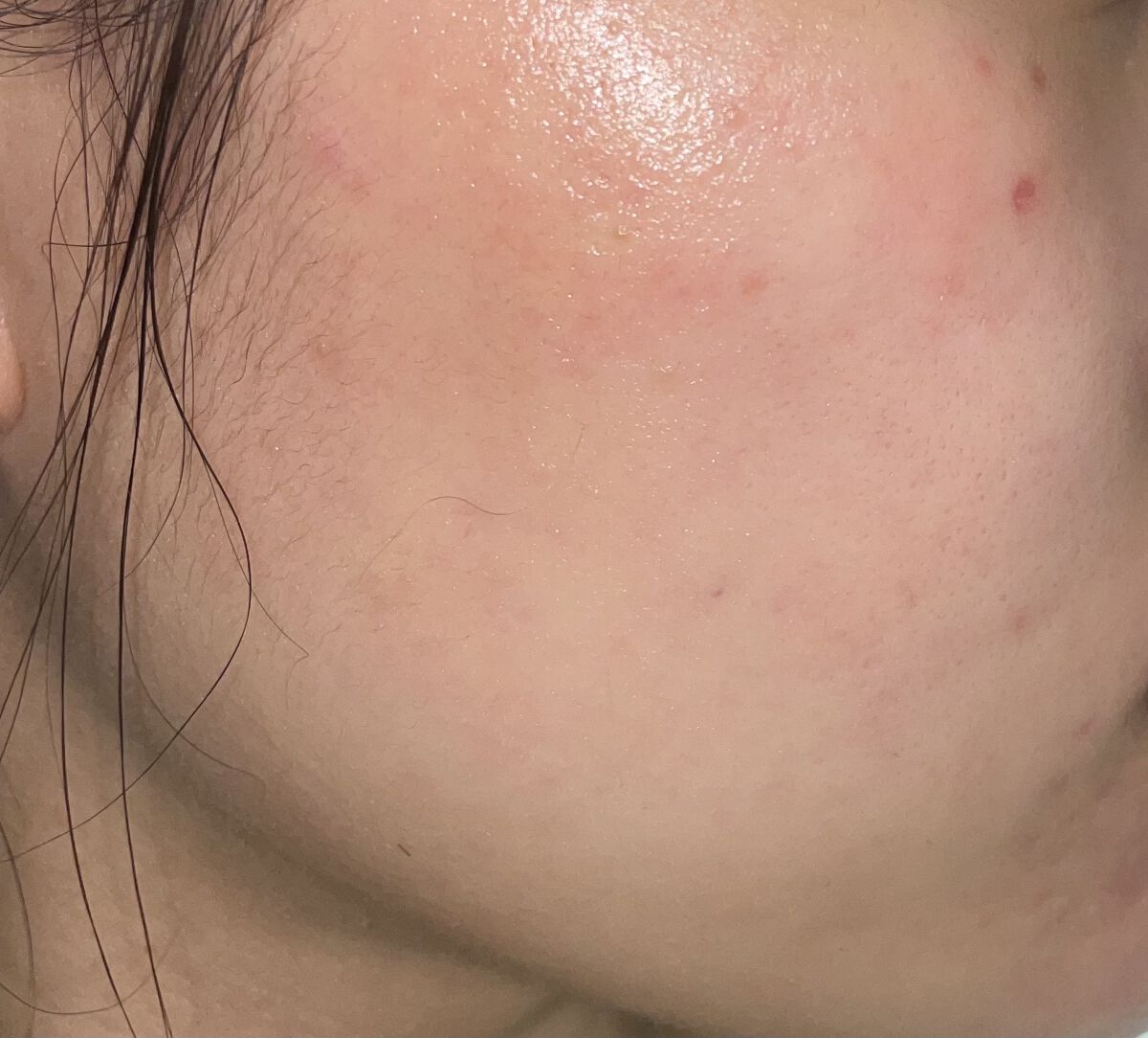 アダパレンゲル/日本ジェネリック/その他を使ったクチコミ（2枚目）