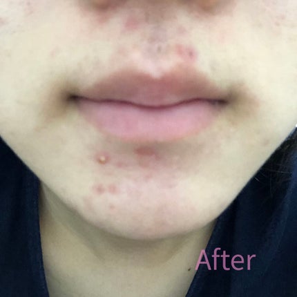 ハトムギ化粧水(ナチュリエ スキンコンディショナー R )/ナチュリエ/化粧水を使ったクチコミ(4枚目)