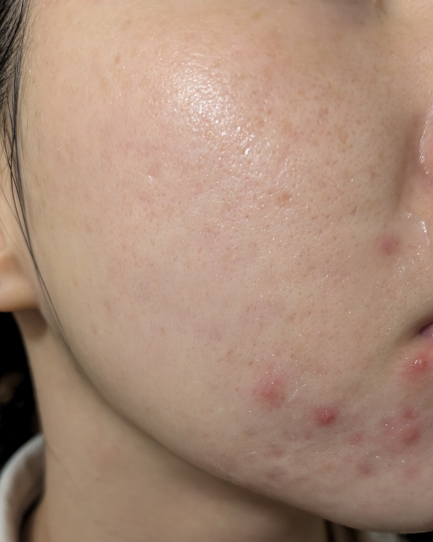 11/7の#汚肌工事録

一気に荒れてる😳