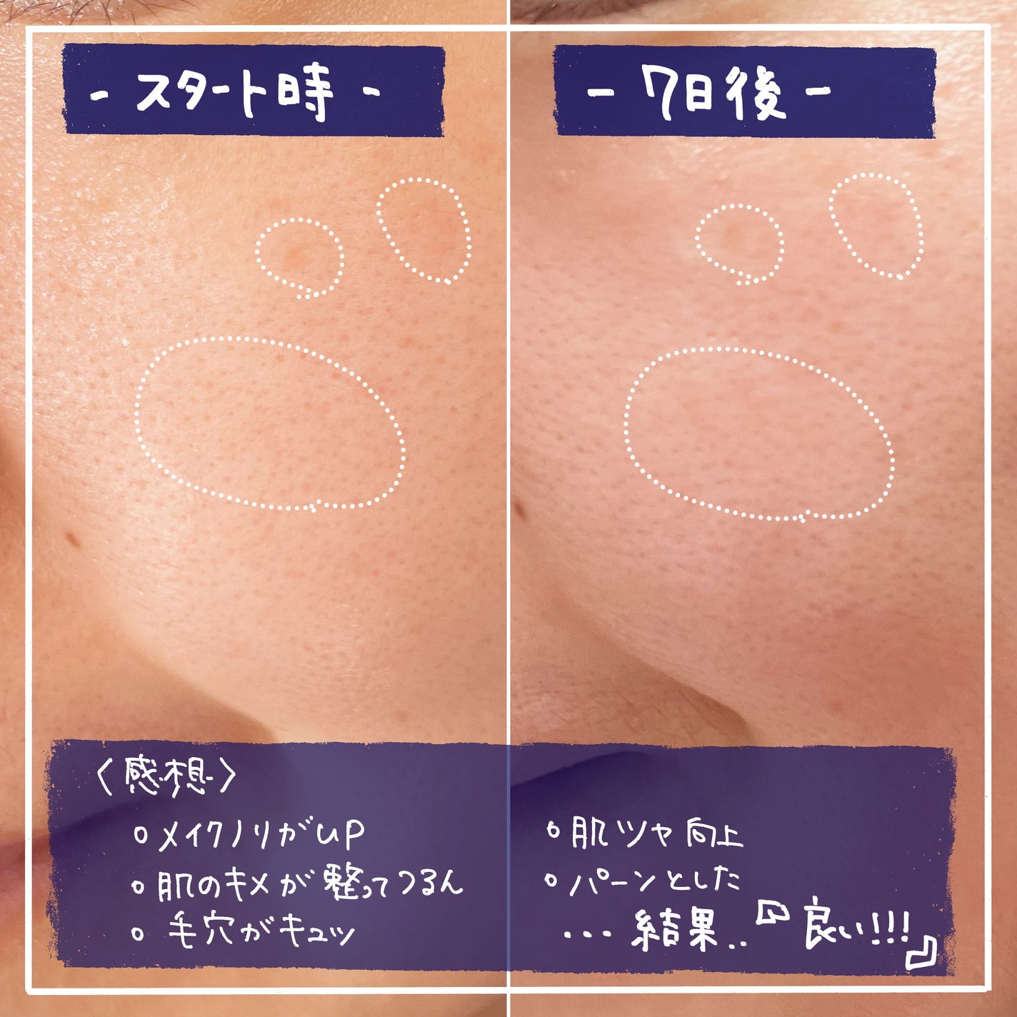 yuna  フォロバします♡ on LIPS 「ネリちゃんず4期生ミッション!!発売前のネイリパの美容液7日間..」(3枚目)