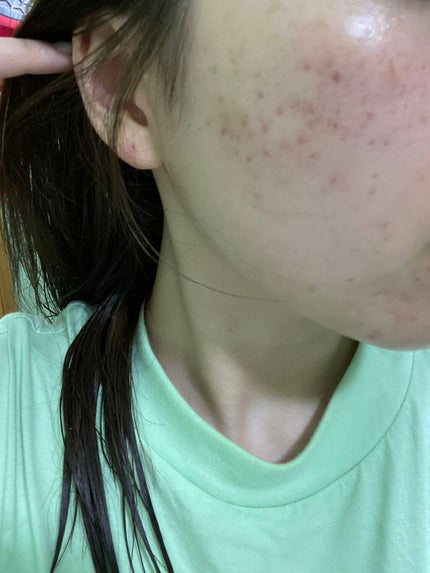 ロゼット洗顔パスタ アクネクリア/ロゼット/洗顔フォームを使ったクチコミ(2枚目)