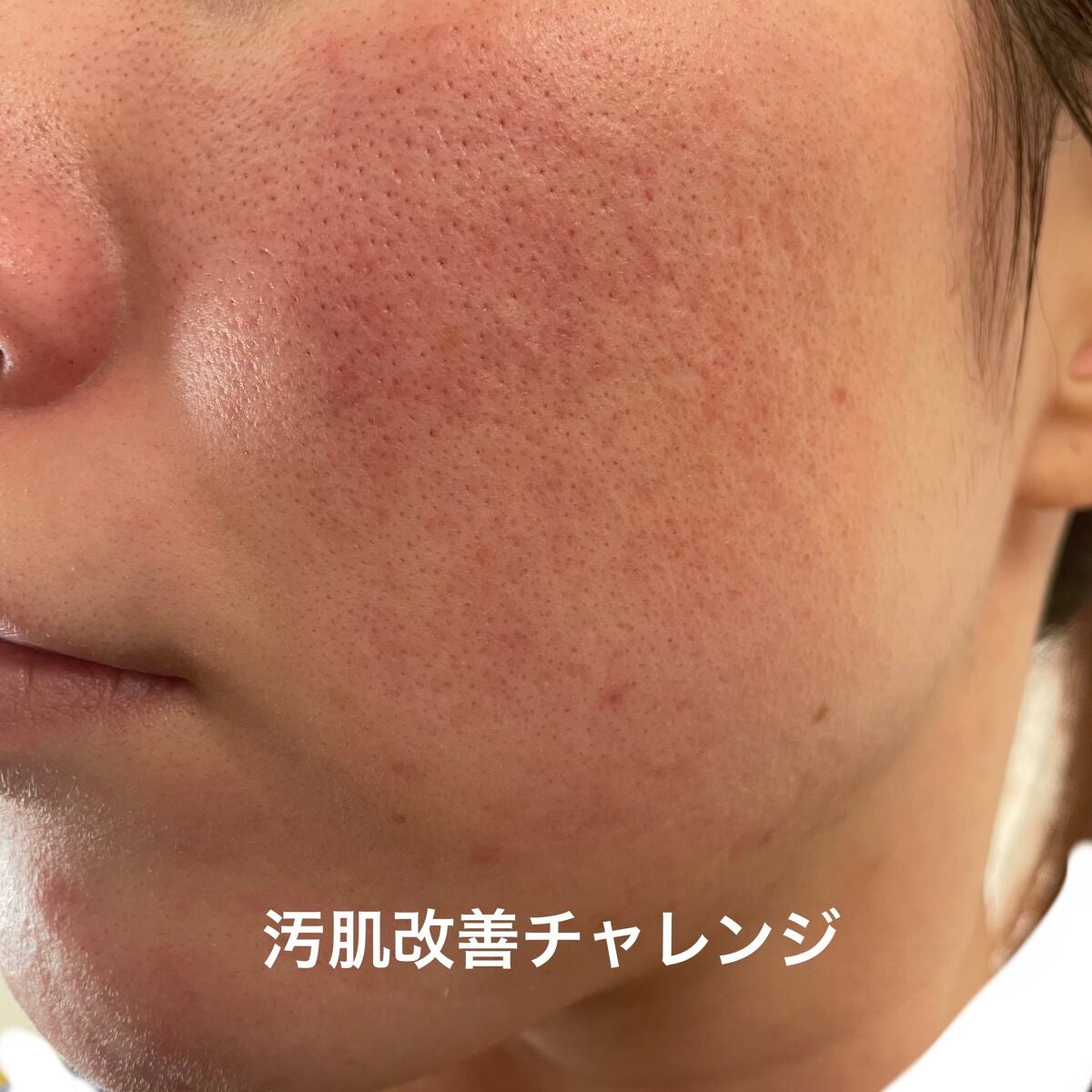 Daisy on LIPS 「\お肌日記/赤み再発😰😱毛穴開きが目立つ😰なんてこった、、、、..」(2枚目)