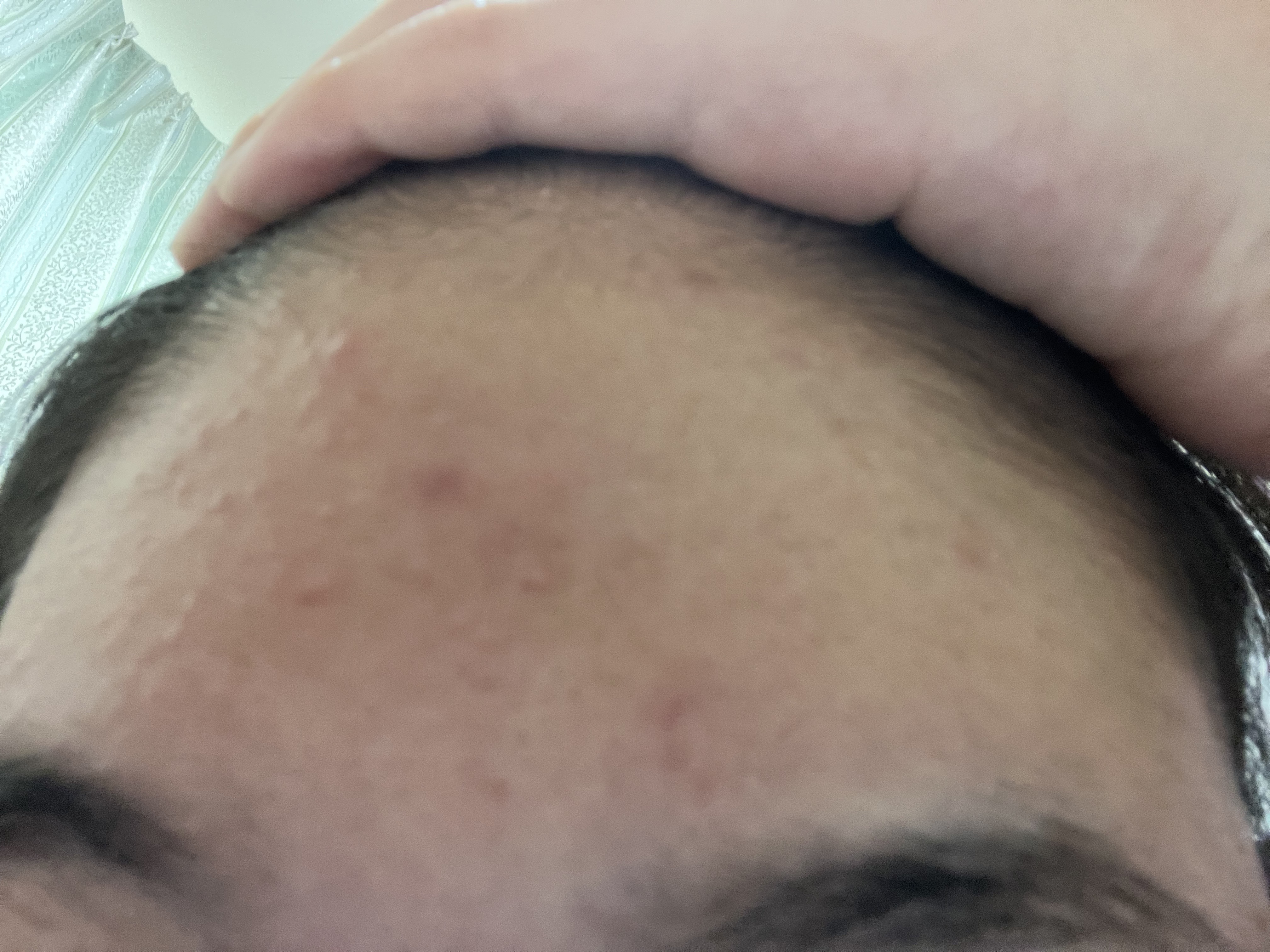 ニキビ治療薬(医薬品)/メンソレータム アクネス/その他を使ったクチコミ（3枚目）